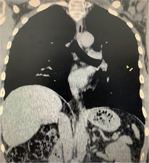 Chest CT image for re-evaluation after 5 months.