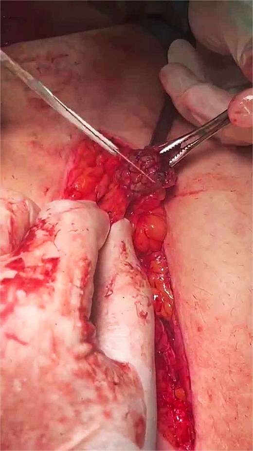 Intraoperative image showing a firm, irregular, nodular lesion measuring ~2.5–3 cm on the anterior peritoneal surface. The lesion has a reddish-brown appearance and is being carefully excised using surgical forceps and scissors. It was incidentally discovered during abdominal closure in an emergency cesarean section, unrelated to the surgical field or previous scar site.