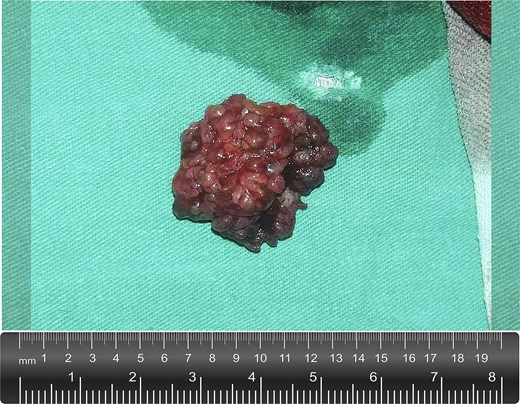 Gross appearance of the excised lesion. The mass measured ~2 × 3 cm, with an irregular, lobulated contour and a grayish-red external surface. It was of moderate to firm consistency. The cut surface revealed a lobulated, whitish appearance.