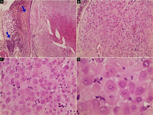 Histopathological features of the excised lesion (hematoxylin and eosin stain): (A) low-power view showing decidualized endometrial stroma with adjacent endometrial glands; blue arrows indicate the overlying peritoneal tissue (40×). (B) Intermediate magnification revealing decidualized stromal cells with abundant eosinophilic cytoplasm and centrally located nuclei, consistent with pregnancy-related changes (100×). (C) High-power view showing uniform polygonal decidualized stromal cells without cytological atypia or malignancy (200×). (D) Close-up of decidualized stroma highlighting the prominent, round nuclei and abundant cytoplasm, confirming the benign nature of the lesion (400×).