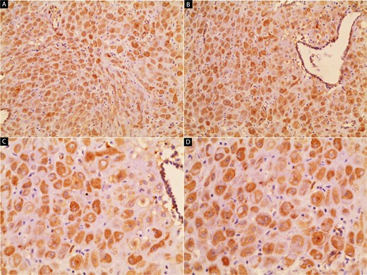 Immunohistochemical staining for CD10. The stromal component of the lesion shows strong, diffuse cytoplasmic positivity, confirming its endometrial stromal origin and supporting the diagnosis of decidualized endometriosis. Images (A) and (B) show 100× and 200× magnifications, respectively.