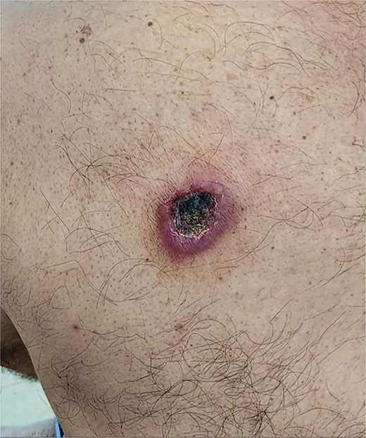 Clinical image showing an erythematous, firm nodule with a central necrotic crust located on the upper back.