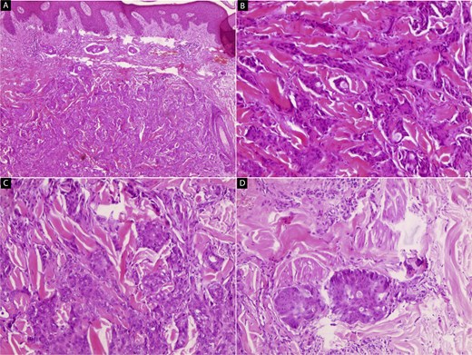 Hematoxylin and eosin (H&E) stained microscopic images of the skin lesion. (A, B) Low-power views reveal a poorly circumscribed, infiltrative tumor within the dermis. The tumor is composed of irregular cords and nests of atypical cells dissecting between collagen bundles, with focal glandular differentiation (40× and 100×). (C, D) High-power views show large polygonal tumor cells with abundant eosinophilic cytoplasm and pleomorphic, vesicular nuclei containing prominent nucleoli, resembling hepatocytic morphology. The tumor exhibits irregular infiltration into the subcutaneous fat and adjacent soft tissue (200× and 400×).