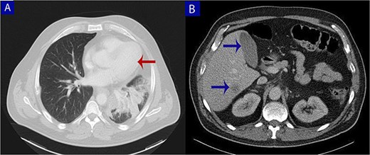 Contrast-enhanced computed tomography (CT) of the chest, abdomen, and pelvis. (A) Axial chest CT shows a lobulated mass (arrow) with heterogeneous enhancement centered at the left pulmonary hilum, invading adjacent bronchial and vascular structures. (B) Abdominal CT reveals multiple hypodense lesions in the liver (arrows), consistent with hepatic metastases.