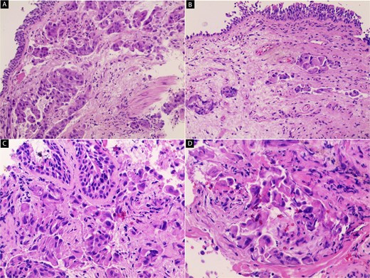 Hematoxylin and eosin (H&E) stained sections of the primary lung tumor. (A, B) Low-power views show an infiltrative tumor composed of irregular nests and trabeculae of malignant cells within desmoplastic stroma. The tumor lacks a well-defined boundary and infiltrates surrounding connective tissue (40×). (C, D) High-power views demonstrate large polygonal tumor cells with abundant eosinophilic cytoplasm and centrally located pleomorphic nuclei with prominent nucleoli. These cells exhibit a hepatoid (hepatocyte-like) morphology (100× and 200×).