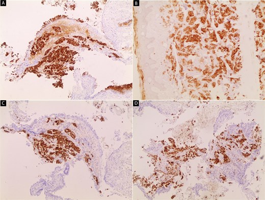 Immunohistochemical staining of the primary lung tumor.