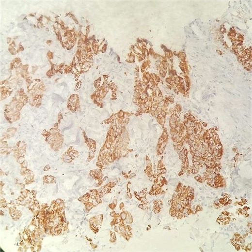 Immunohistochemical staining for HepPar-1 on the skin metastasis biopsy, showing positive cytoplasmic staining in tumor cells.
