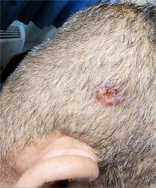 Clinical image showing a painless, ulcerated scalp nodule that appeared ten days after the initial skin lesion.