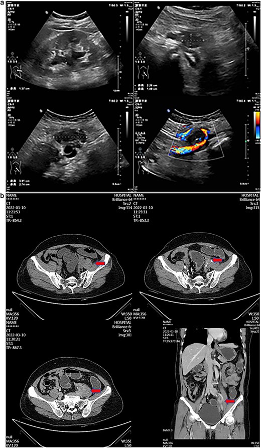 (a) Transabdominal ultrasound image showing hypoechoic and mixed-echoic masses adjacent to left iliac vessels with associated mild left Hydronephrosis and mid-ureteral compression. (b) Contrast-enhanced CT image demonstrating ring-enhancing left adnexal mass and left iliac vessel nodule with associated ureteral compression and mild hydroureteronephrosis.
