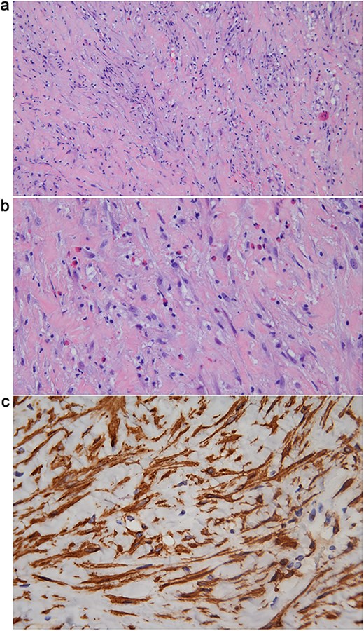 (a) Hematoxylin & Eosin (H&E) stain (10 × 10) showing proliferation of myofibroblasts with infiltration of eosinophils and lymphocytes, and intercellular collagen deposition. (b) H&E stain (10 × 20) showing proliferation of myofibroblasts with infiltration of eosinophils and lymphocytes, and intercellular collagen deposition. (c) Immunohistochemical staining for SMA (10 × 40) demonstrating cytoplasmic positivity in the proliferative spindle tumor cells.