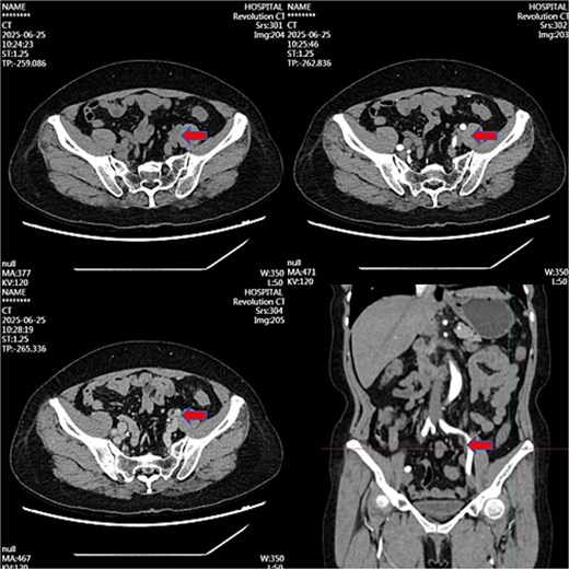 Contrast-enhanced CT image at 36-month follow-up demonstrating near-complete resolution of previously described left iliac vessel mass following medical therapy.