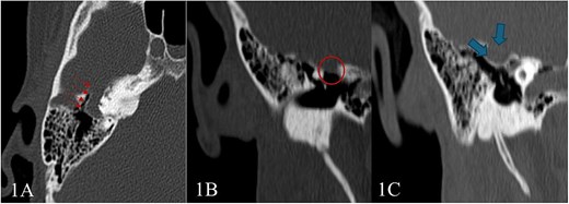 High-resolution CT scan of the temporal bone shows: (A) Tubular lucency noted lateral to superior semicircular canal with associated dehiscence. (B and C) Scalloping and protrusion of right tegmen tympani into epitympanum with a marked narrowing of epitympanum recess. Additionally, there is a lateralization of ossicular chain and apparent subluxation of incudomalleolar joint.