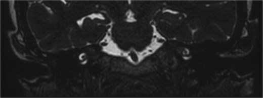 Coronal T2 FIESTA confirm the absence of encephalocele.