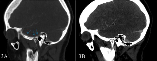 Consecutive images from late arterial phase CT scan reveals; the vascular nature of aforementioned observation which drain into dural venous sinus.
