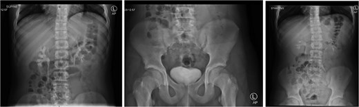 Abdomen/KUB X-ray: Revealed no evidence of intestinal obstruction or pneumoperitoneum in this study.