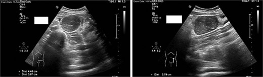 An abdominal ultrasound, which showed a hypoechoic mass in the left lower abdomen, and minimal free fluid.