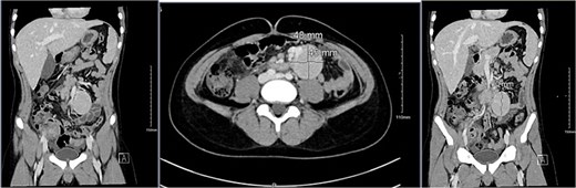 A CT scan of the abdomen revealed an appendicular abscess measuring ⁓40 mL with an associated appendicolith and a soft tissue mesenteric mass measuring 6 × 4 cm, accompanied by enlarged mesenteric lymph nodes.