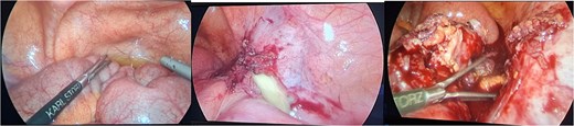 Intra-operative findings included a gangrenous perforated appendix with a right pelvic pus collection.
