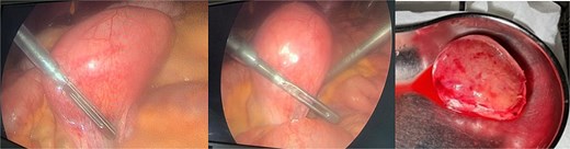 Intra-operative findings, a mesenteric mass measuring 6 × 4 cm was noted ⁓70 cm away from the ligament of Treitz distally.