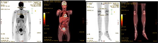 PET scan showed no evidence of hypermetabolic malignancy or lymphoproliferative disease or residual disease.