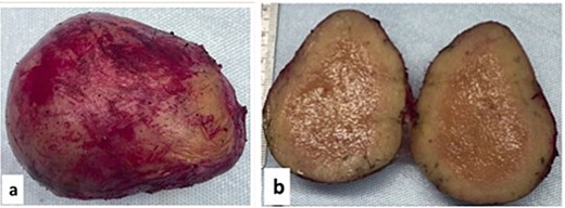 Gross examination (a, b): Mesenteric oval mass (6 cm) with gray homogenous cut surface.