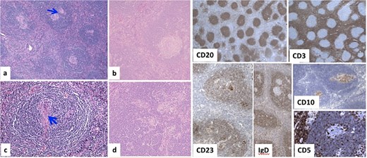 Microscopically, (a) HE × 100: Lymph node showing regressive lymphoid follicles with small and ‘twining’ germinal centers (GC) (arrow). (b, d) HE × 200: Inter-follicular vascular proliferation. (c) HE × 400: Expanded mantle zone, tend to form concentric rings, ‘onion skin pattern’, blood vessels penetrate the GC, ‘lollipop follicle’.