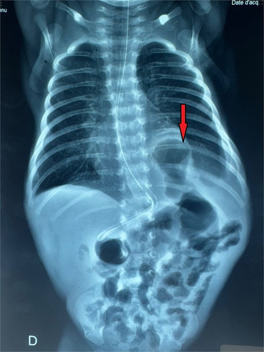 Thoracoabdominal radiograph showing air-filled bowel loops within the thoracic cavity (arrow) with absent visualization of the diaphragmatic contour, consistent with a CDH.
