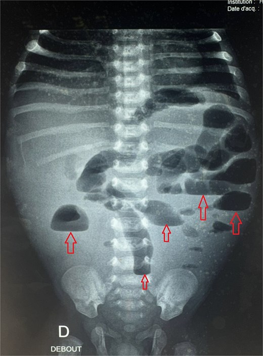 Postoperative abdominal radiograph demonstrating multiple air-fluid levels (arrows) without evidence of significant colonic dilatation.