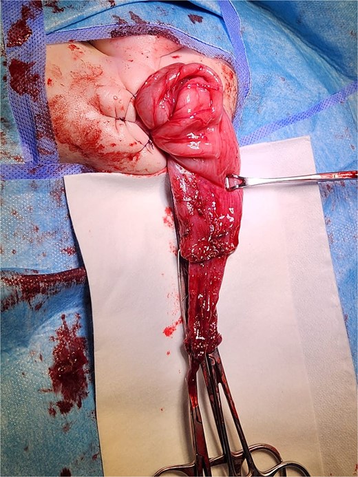 Intraoperative view of a transanal endorectal pull-through (soave procedure) for HD.