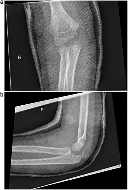 (a, b) Initial radiographs after closed reduction, showing proximal ulna and radial neck fractures.