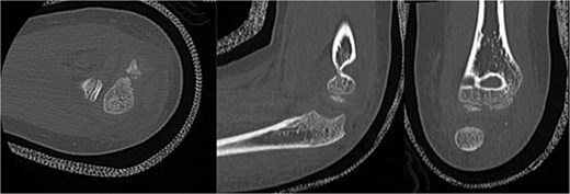 CT scan demonstrating radial neck angulation, radiocapitellar subluxation, and linear calcification near the trochlear notch.