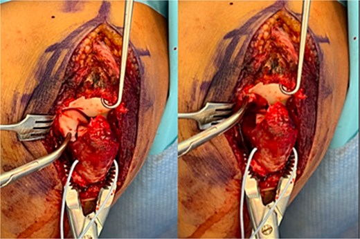 Intraoperative photographs showing a large chondral shear fragment involving the trochlear notch, visualized prior to reduction.