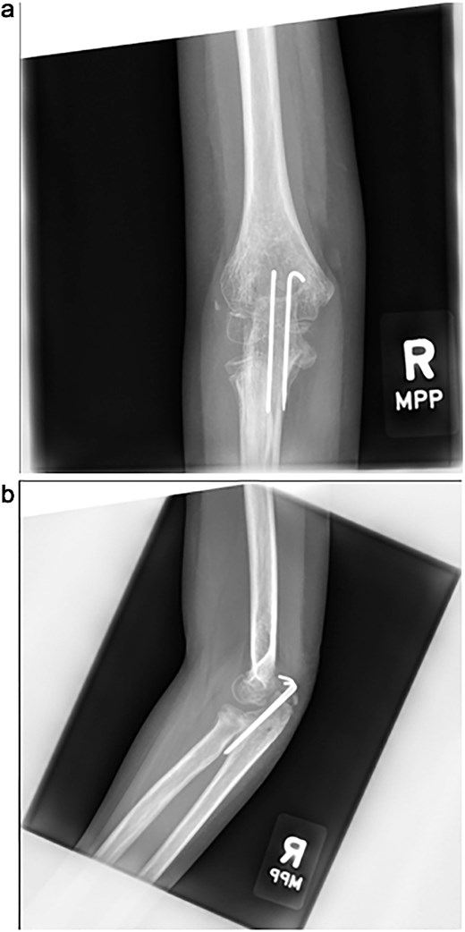 (a, b) Radiographs at 5 weeks, showing maintained alignment at the time of cast removal.