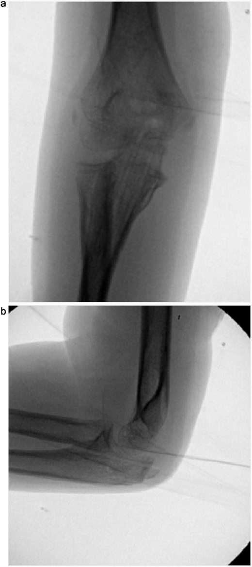 (a, b) Intraoperative fluoroscopic images following hardware removal at 4 months, demonstrating restoration of joint congruity.