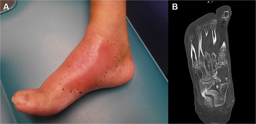 (A) The initial appearance of the affected right foot shows swelling and oedema at the dorsomedial aspect of the midfoot. The CT scan shows that the medial midfoot column has a bony defect following debridement for a late-onset infection. (B) This infection occurred after failed reconstructive attempts using avascular autologous bone grafts and arthrodesis.