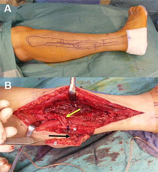 (A) The fibula bone graft resection sites and the perforator-based skin flap are marked. Perforator mapping was performed using colour-coded duplex ultrasound. The intraoperative situation (B) clearly shows the main pedicle containing the fibular artery (top arrow), the vascularized fibula bone graft (*), and the perforator-based (bottom arrow) soft-tissue island (#).