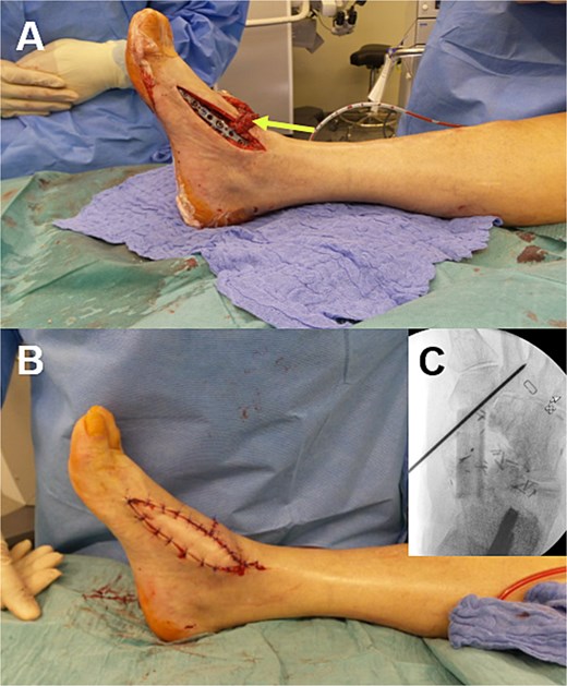 (A) The vascularized bone graft is fixed using a low-profile medial column plate. We ensure that the perforator to the skin island (arrow) and the main pedicle of the chimeric flap are carefully preserved during plate fixation. (B) The final intraoperative result. It demonstrates proper coverage of the soft tissue defect and plate by means of the perforator-based skin island. (C) An intraoperative X-ray scan of the temporarily fixed bone graft with a K-wire.