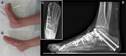 Six months after surgery, the final result shows a stable coverage with an adequate range of active motion regarding (A) dorsal extension and (B) plantar flexion. (C, D) The bone graft is fully integrated.