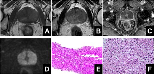 (A) High signal on T1-weighted imaging. (B) Low signals on T2-weighted imaging. (C, D) Restricted diffusion was observed on diffusion-weighted imaging and apparent diffusion coefficient. (E) The pathological results of transperineal prostate puncture surgery. (F) The pathological results of prostate laser enucleation surgery.