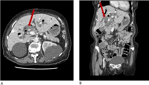 CT abdomen and pelvis showing common bile duct dilatation (arrow) with biliary stents in situ and incidental hepatic hemangioma in (A) axial plane and (B) coronal plane.