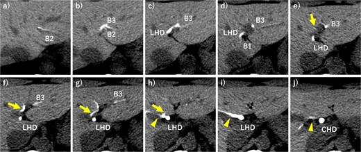 Axial view of drip infusion cholangiography with CT (DIC-CT). The left medial sectional bile duct (arrows) joined the right hepatic duct (arrowheads) (a–j) B1, bile duct of Segment 1; B2, bile duct of Segment 2; B3, bile duct of Segment 3; LHD, left hepatic duct; CHD, common hepatic duct.