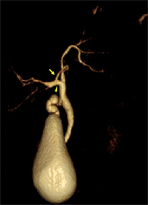 Three-dimensional DIC-CT showing the left medial sectional bile duct (arrow) joined the right hepatic duct (arrowhead).
