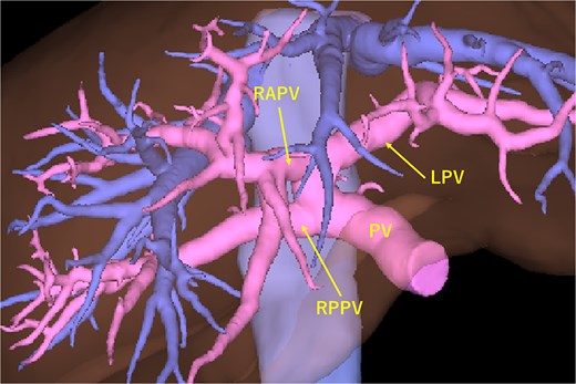 The portal vein diverges into the RPPV and the common trunk of the RAPV and LV. RAPV, right anterior sectoral portal vein; RPPV, right posterior sectoral portal vein; LPV, left portal vein; PV, portal vein.