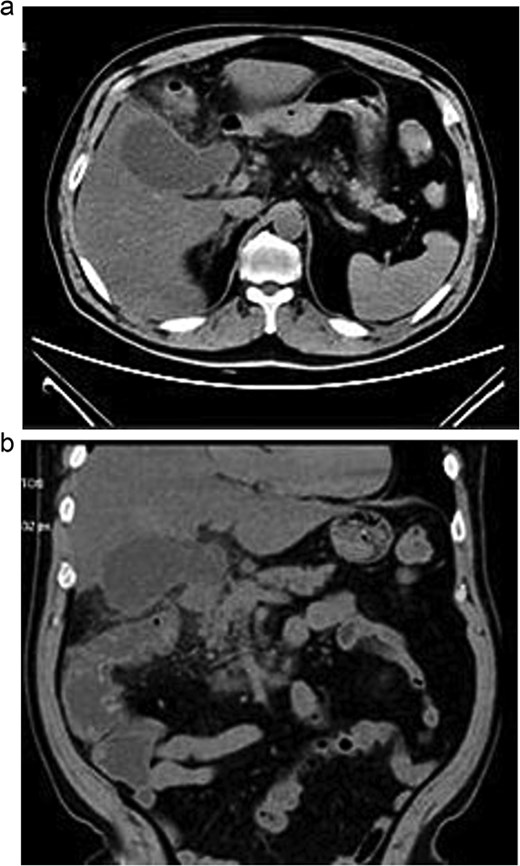 Axial (a) and coronal (b) abdominal CT showing gallbladder hydrocholecystosis.