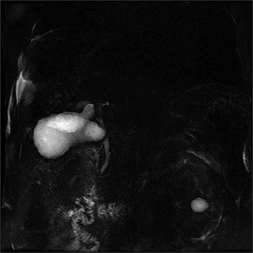 MRCP showing duplicated gallbladder (H-type), with two independent cystic ducts draining into the common bile duct.
