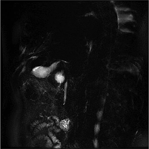 MRCP (thick-slab 2D coronal oblique) showing duplicated gallbladder (H-type) with two independent cystic ducts and no evidence of choledocholithiasis.