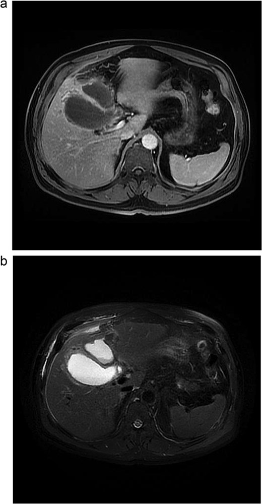 Abdominal MRI. (a) Axial 3D T1 LAVA-Flex water-only sequence, venous phase. (b) Axial T2 PROPELLER sequence with fat suppression.