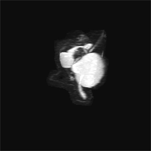 3D T2-weighted MRCP with maximum intensity projection (MIP), showing duplicated gallbladder (H-type) and biliary anatomy.