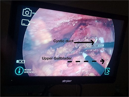 Intraoperative laparoscopic view. Solid arrow: Cystic duct with polymer clip. Dashed arrow: Upper gallbladder removed from its original position.