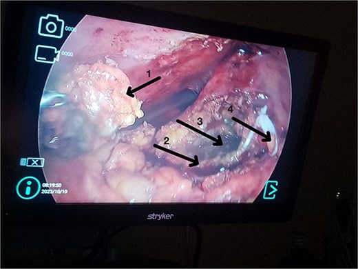 (1) Anterior wall of the inferior gallbladder. (2) Posterior wall of the inferior gallbladder. (3) Necrotic area of the posterior wall of the inferior gallbladder. (4) Upper gallbladder removed from its original position.